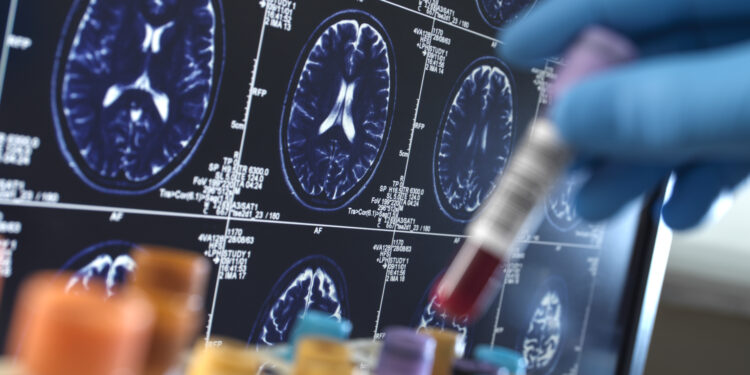 United Kingdom, High Wycombe, Alzheimer's and Dementia Research, Scientist holding a blood sample during a clinical trial with a MRI on screen